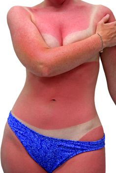 How To Cure A Sunburn Quickly