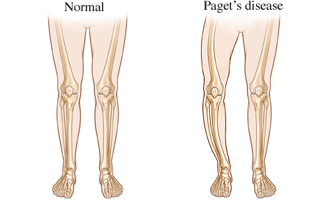 The Symptoms of Pagets Disease