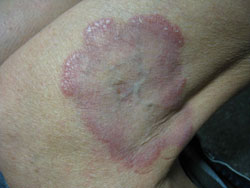 Treatment Options For Granuloma Annulare